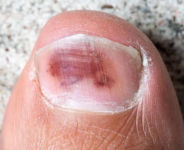 Fungal-Infection-001-2