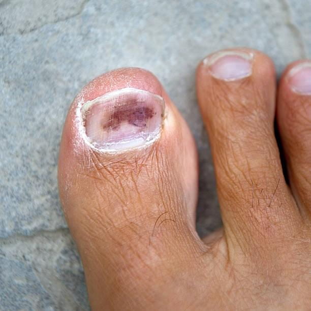 Infected-Toenail-001