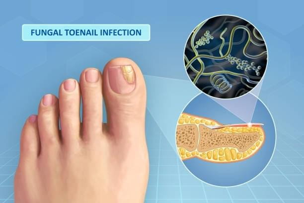 biofilm-force-field-inside-your-toenail-001