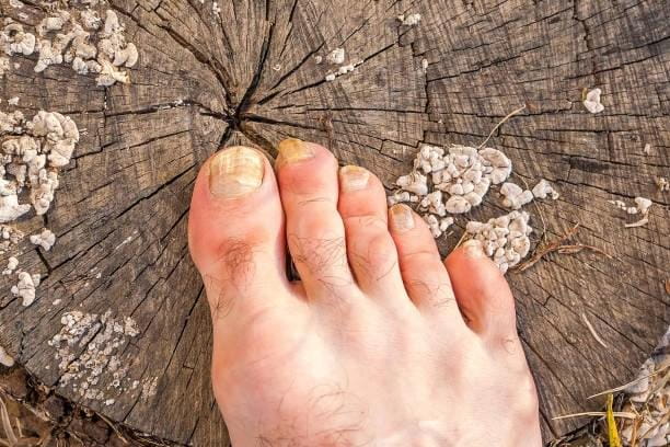 stubborn-toe-fungus-001