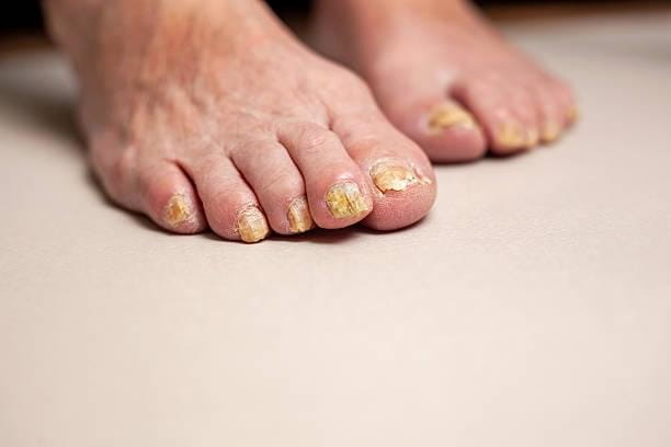 toenails-fungus-001