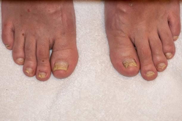 yellow-crusty-nails-001